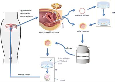 Progress in <mark class="highlighted">Fertility Preservation</mark> Strategies in Turner Syndrome